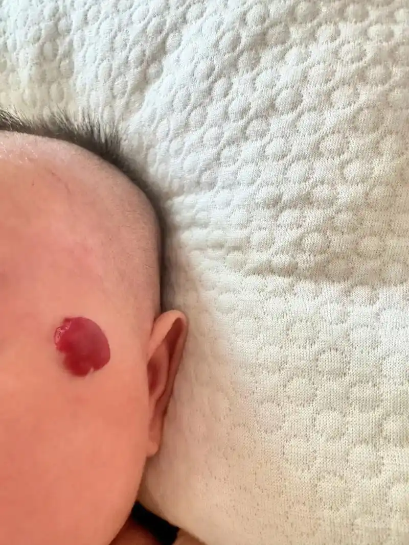 作品里的血管瘤,有没有一款跟你家宝宝的血管瘤一样的,有的话在打出来