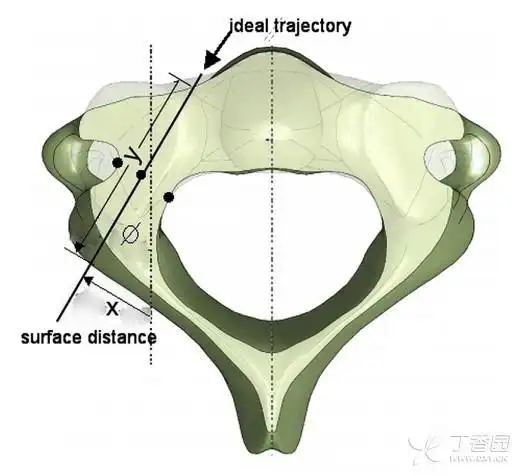 c2椎弓根螺钉的理想轨迹