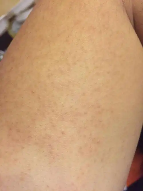 胳膊上这个点点怎么能去掉