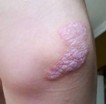 抓一抓有白屑掉下来.