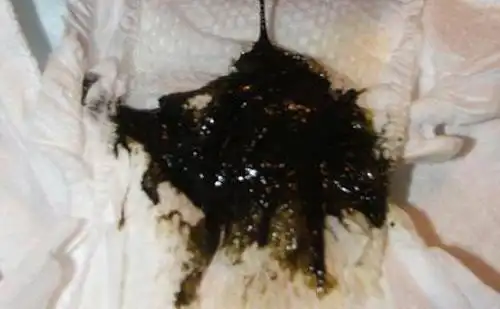 牢记这4个信号尤其是第1个说明胃癌症离你不远了