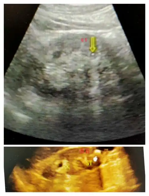 【秀医超声小课堂】——肾脏内的强回声不一定是结石