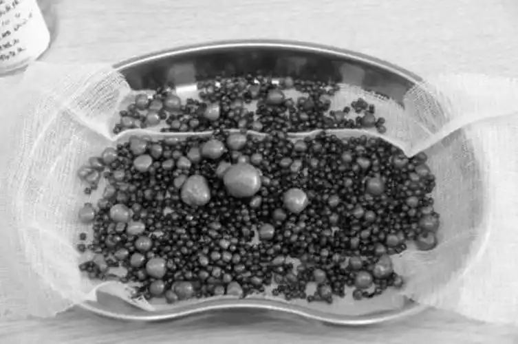 肾结石疼痛位置图片