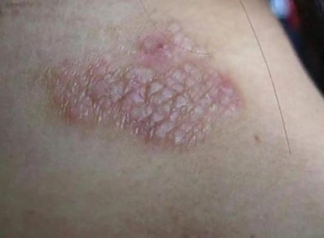 神经性皮炎越来越严重怎么办?