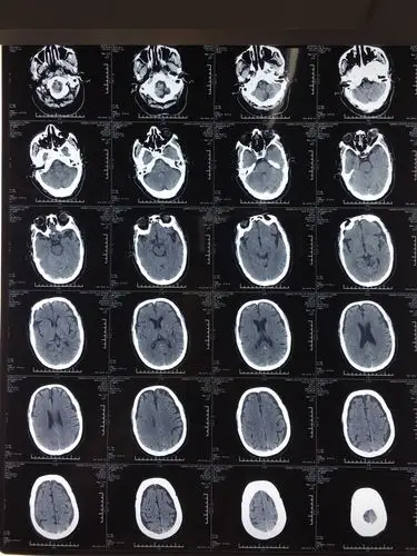 患者虽然已80岁,脑萎缩及脑梗死并不严重.