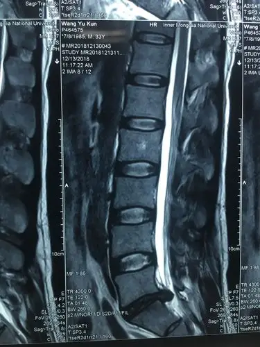 一例腰5骶一间盘脱出症脊柱内镜微创治疗病例