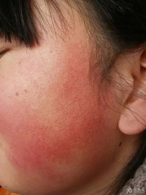 病例分享:面颈部毛囊红斑黑变病.