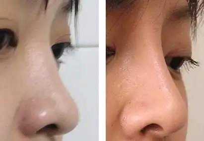 对于隆鼻后多久恢复自然分析