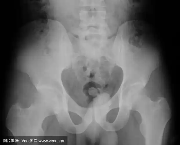 男性骨盆外伤x光片