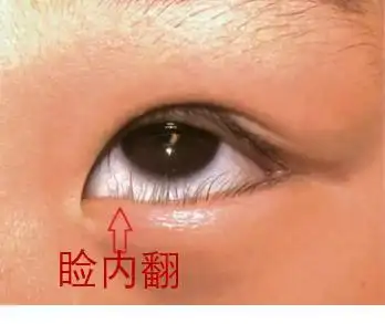 孩子怕光爱流泪警惕先天性睑内翻倒睫