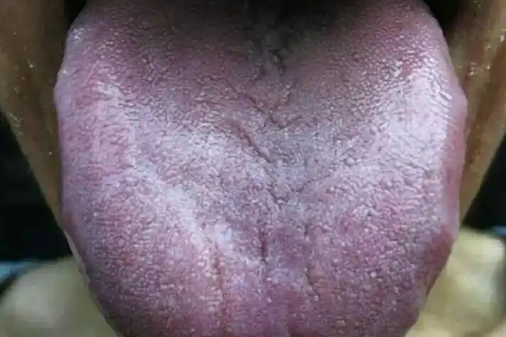 绛紫舌图舌头有紫斑图发生机制气血运行不畅,舌体血络亦随之变为青紫