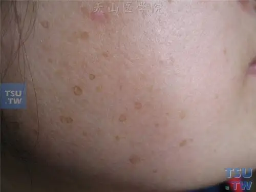汗孔角化症(porokeratosis of mibelli)症状表现