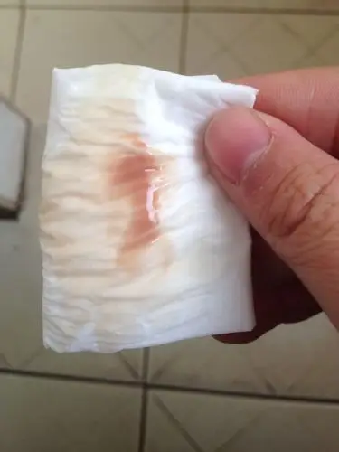 到了来例假的时间没来例假而是白带里面有黑血,已经五天了,验孕棒显示