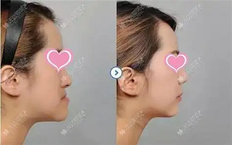 骨性地包天做正颌手术前后对比图