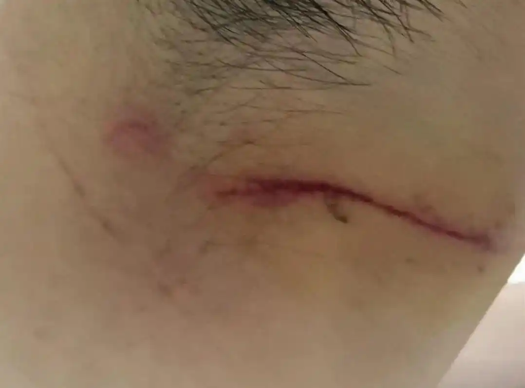 脖子上被小刀割的伤口(受访者提供)