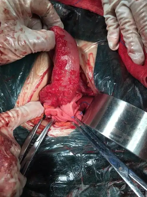 今日夜班遇妇产科手术台上会诊.向各位老师请教