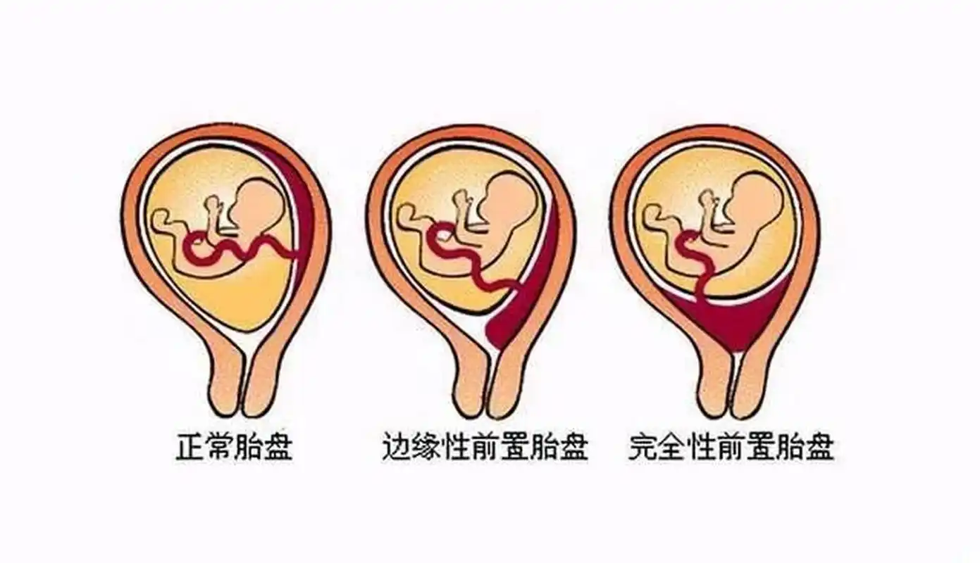 孕早期胎盘下缘覆盖宫颈管内口怎么办?