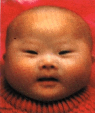 唐氏综合征无创产前基因检测