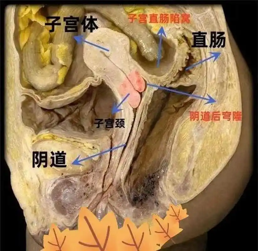 人体解剖|[石化]  阴道后穹窿,是女性的一个解剖结构,男人没有,它就是