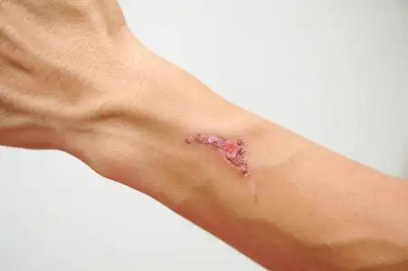 烫伤疤痕手臂造成的疤痕照片