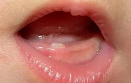 宝宝早长牙好还是晚长牙好 可能很多家长误解了