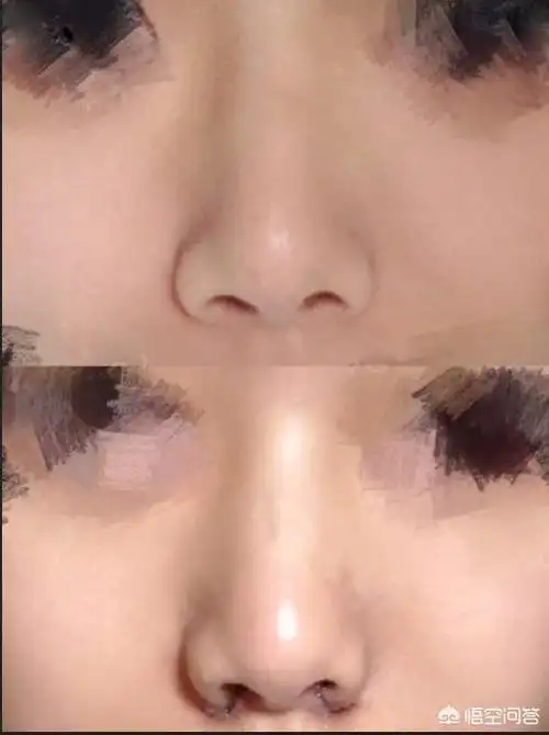 头条问答 - 鼻子大,怎么整容比较好?(8个回答)