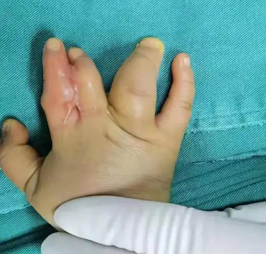 并指手术后出现瘢痕粘连,二次手术后恢复的效果很不错_先天性并指多指