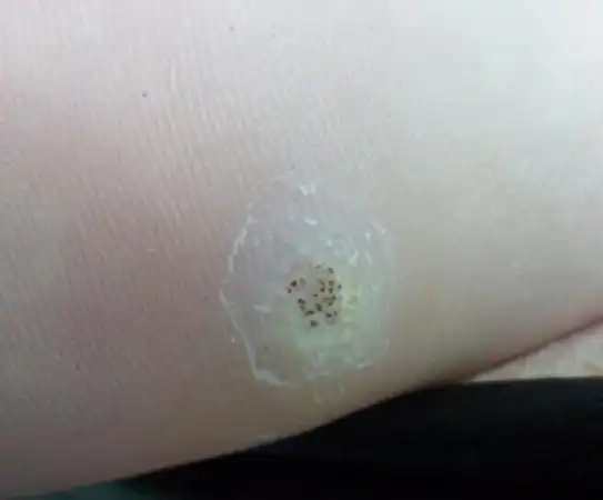 我是内科的请皮肤科老师看看这个"鸡眼"上面黑色的像芝麻一样的东东西