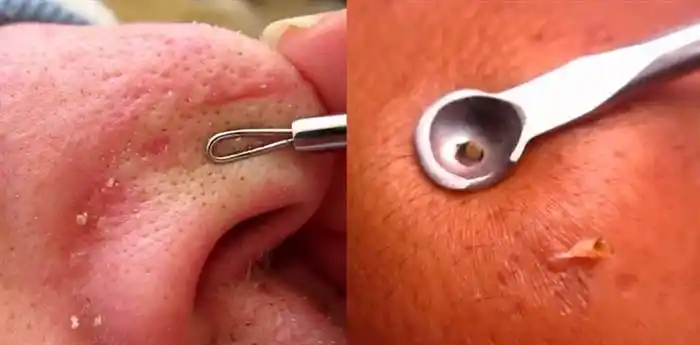 毛孔粗草莓鼻的解决方法