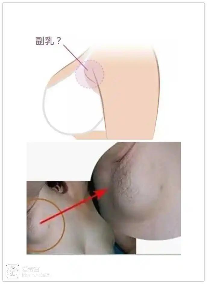 别让产后副乳,成为你身体的毒瘤.