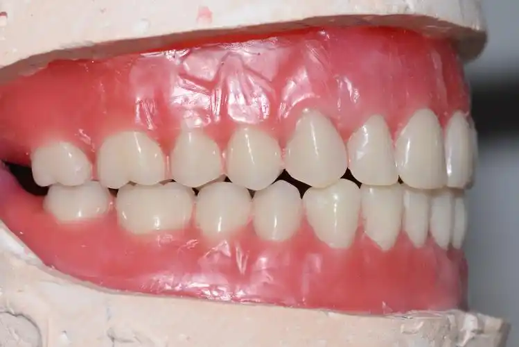 两个翅膀的全口义齿