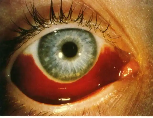 糖尿病并发症 图片4.jpg(2008-10-17 12:00 上传) 原图尺寸 76.