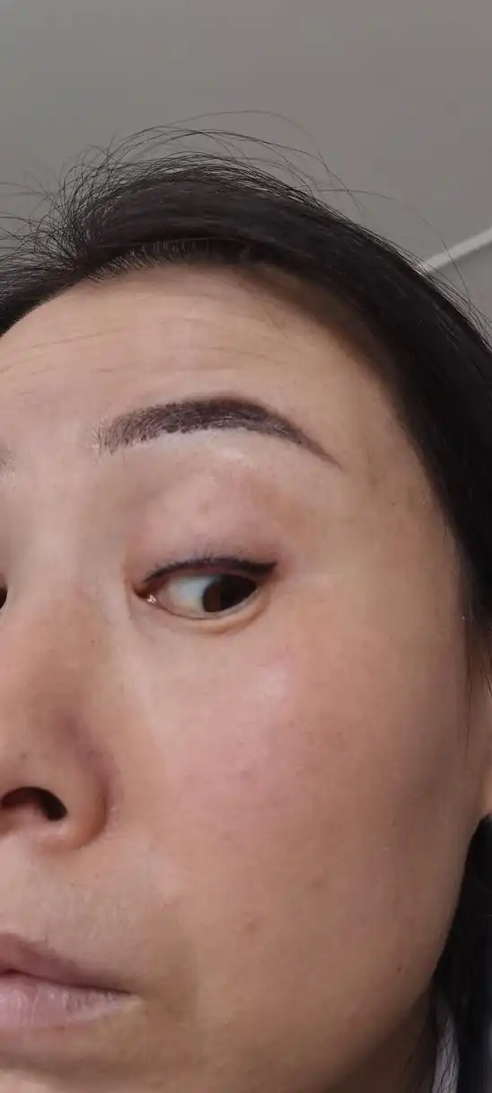 这是美瞳线补色后,十一天都不掉痂,结痂很厚,掉后就是一节有一节没有