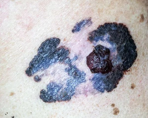 再次提醒长在9个部位的痣与癌症密不可分要及时处理