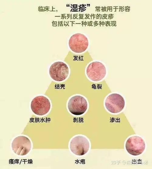 2021年9月更新史上最全面新生儿宝宝湿疹热疹各种疹分辨方法及护理