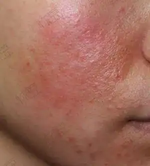 敏感肌知多少过敏了就是敏感肌了