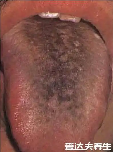 超详细胃癌早期舌头图片,舌苔发黑无知觉一定要引起重视