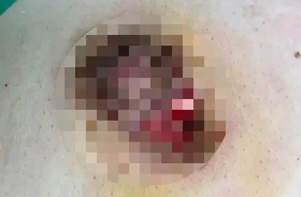 少妇乳房脓疡「抽出6㏄」像绿豆沙汁液 竟是老公惹的祸