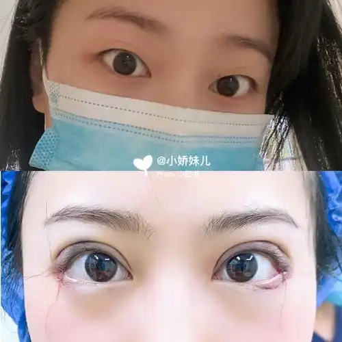 郑州全切双眼皮去皮开内外眼角提肌下至