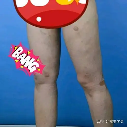 说实在的 大腿抽脂到底会不会凹凸不平,坑坑洼洼.