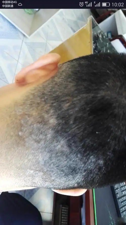 头皮有白斑,有时掉下很大块头皮.