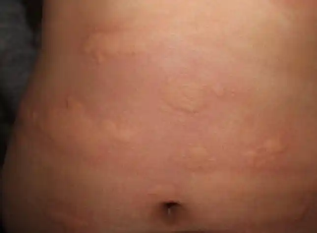 潮湿引起的红疙瘩图片