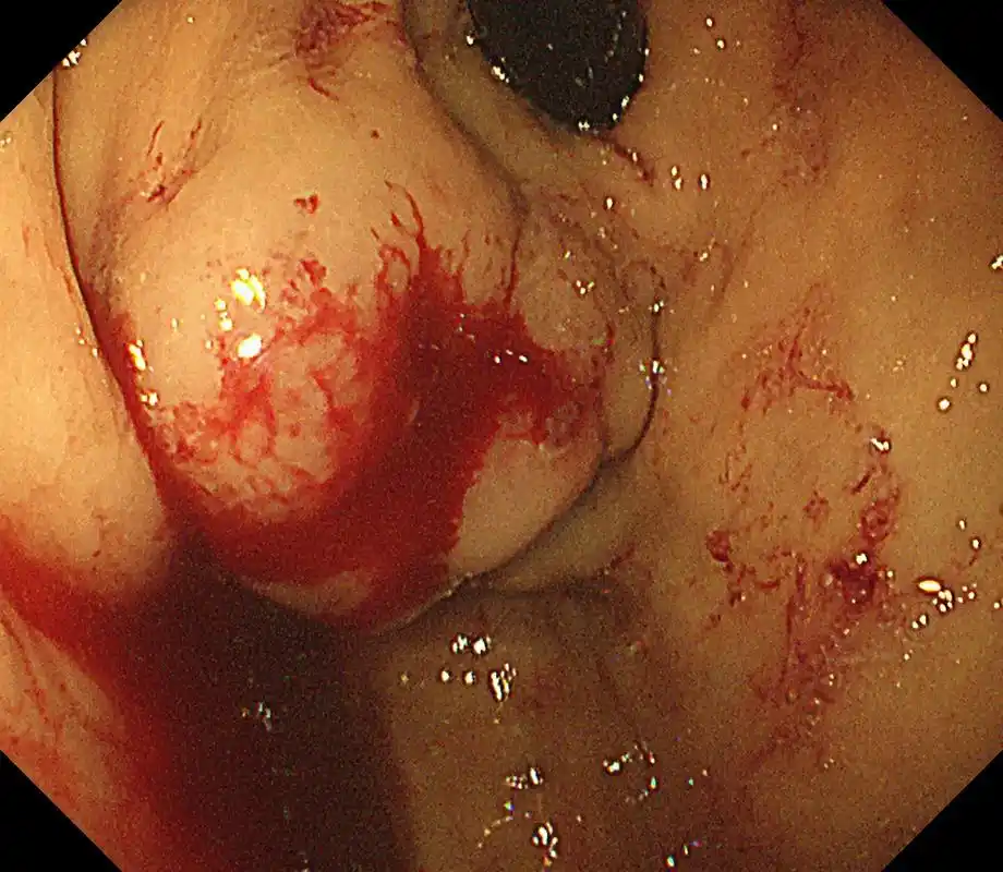 消化道出血 #肝硬化伴胃底静脉曲张破裂出血 #胃镜下止血  - 抖音