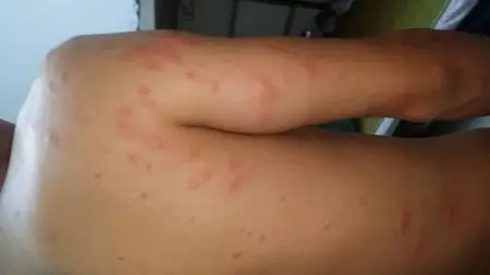 这像虱子咬的么