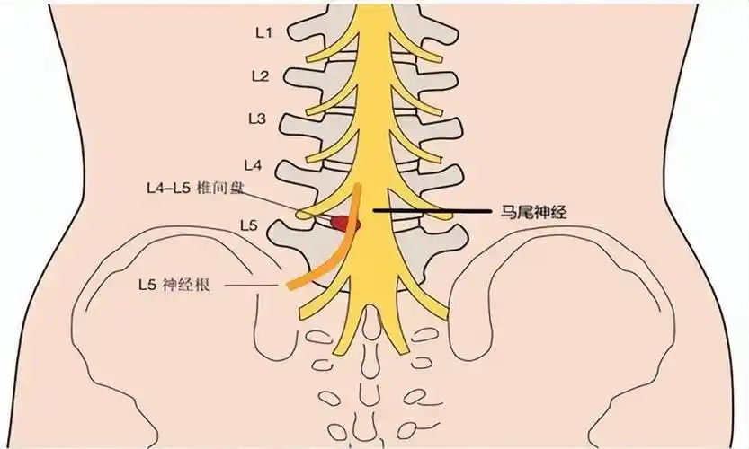 建议你用2种睡姿,舒服不伤腰_腰椎间盘_腰部_患者