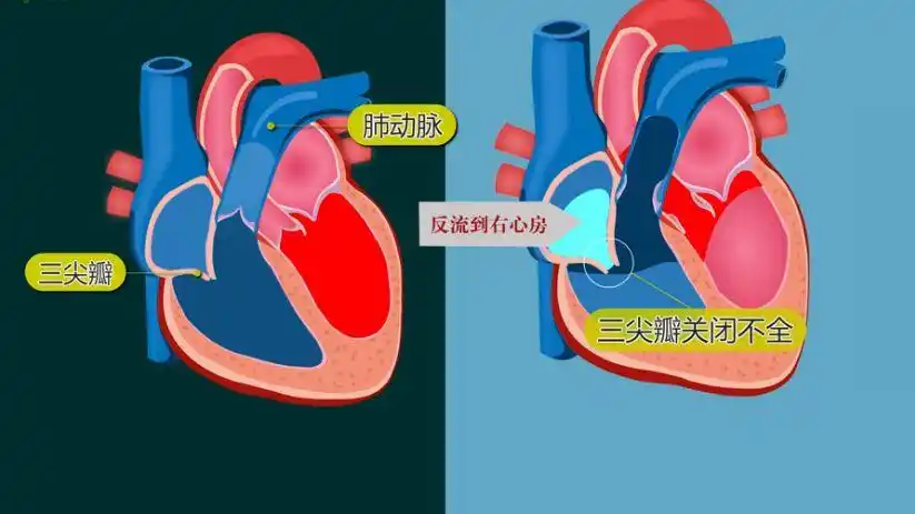 三尖瓣关闭不全是怎么回事?发病前有哪些征兆?
