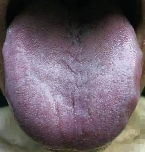 这样的舌头就要警惕癌症