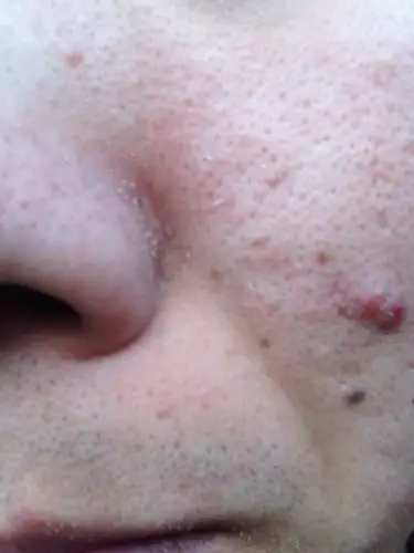 脸上粉刺黑头等等 怎么可以去掉呢?很多年了?挤了也不能去根 还疼.