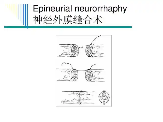 周围神经损伤的评定与康复ppt