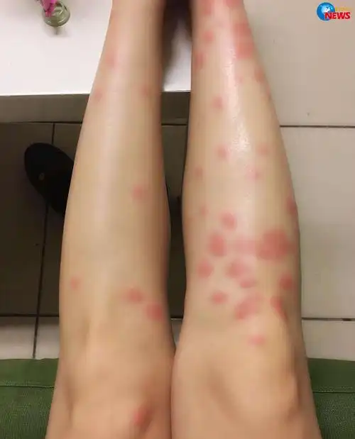 跳蚤咬过后的疙瘩照片家里的跳蚤怎么消灭